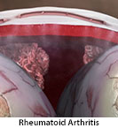 Thumbnail image of: Rheumatoid Arthritis: Animation
