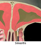 Thumbnail image of: Sinusitis: Animation