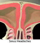 Thumbnail image of: Sinus Headaches: Animation