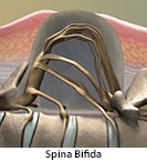 Thumbnail image of: Spina Bifida (pediatric): Animation