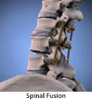 Thumbnail image of: Spinal Fusion: Animation