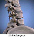 Thumbnail image of: Spinal Instrumentation: Animation