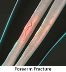 Thumbnail image of: Forearm Fracture (pediatric): Animation