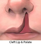 Thumbnail image of: Cleft Lip and Cleft Palate Surgery (pediatric): Animation
