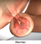 Thumbnail image of: Hernias (pediatric): Animation