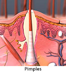 Thumbnail image of: Pimples: Animation