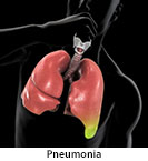 Thumbnail image of: Pneumonia: Animation