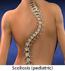 Thumbnail image of: Scoliosis (pediatric): Animation