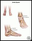 Thumbnail image of: Ankle Sprain: Illustration