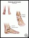 Thumbnail image of: Ankle Sprain: Illustration