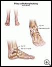 Thumbnail image of: Ankle Sprain: Illustration