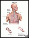 Thumbnail image of: Asthma: Illustration