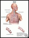 Thumbnail image of: Asthma: Illustration