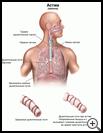 Thumbnail image of: Asthma: Illustration