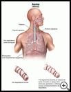 Thumbnail image of: Asthma: Illustration