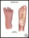 Thumbnail image of: Athlete's Foot: Illustration