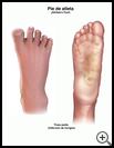 Thumbnail image of: Athlete's Foot: Illustration