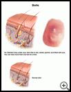 Thumbnail image of: Boils: Illustration