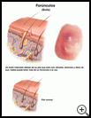 Thumbnail image of: Boils: Illustration