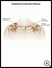 Thumbnail image of: Collarbone (Clavicle) Fracture: Illustration