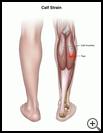 Thumbnail image of: Calf Strain: Illustration