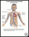 Thumbnail image of: Intravenous (IV) Central Lines: Illustration