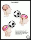 Thumbnail image of: Concussion: Illustration