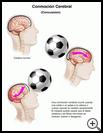 Thumbnail image of: Concussion: Illustration