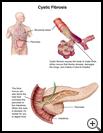 Thumbnail image of: Cystic Fibrosis: Illustration