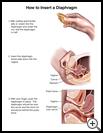 Thumbnail image of: Diaphragm, How to Insert: Illustration