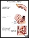 Thumbnail image of: Diaphragm, How to Insert: Illustration