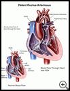 Thumbnail image of: Patent Ductus Arteriosus: Illustration