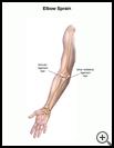 Thumbnail image of: Elbow Sprain: Illustration