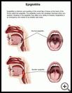 Thumbnail image of: Epiglottitis: Illustration