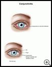 Thumbnail image of: Conjunctivitis: Illustration