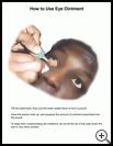 Thumbnail image of: How to Use Eye Ointment: Illustration