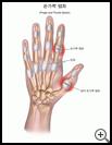 Thumbnail image of: Finger and Thumb Sprain: Illustration