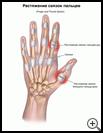 Thumbnail image of: Finger and Thumb Sprain: Illustration