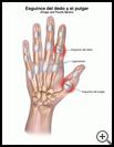 Thumbnail image of: Finger and Thumb Sprain: Illustration