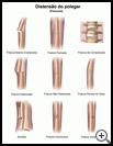 Thumbnail image of: Fractures: Illustration