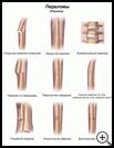 Thumbnail image of: Fractures: Illustration