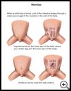 Thumbnail image of: Hernia: Illustration