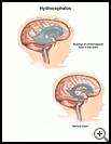 Thumbnail image of: Hydrocephalus: Illustration