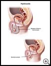 Thumbnail image of: Hydrocele: Illustration