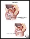 Thumbnail image of: Hydrocele: Illustration