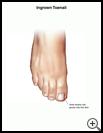 Thumbnail image of: Ingrown Toenail: Illustration