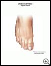 Thumbnail image of: Ingrown Toenail: Illustration