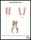 Thumbnail image of: Intoeing (Pigeon Toe): Illustration