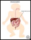 Thumbnail image of: Intussusception: Illustration