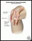 Thumbnail image of: Osgood-Schlatter Disease: Illustration